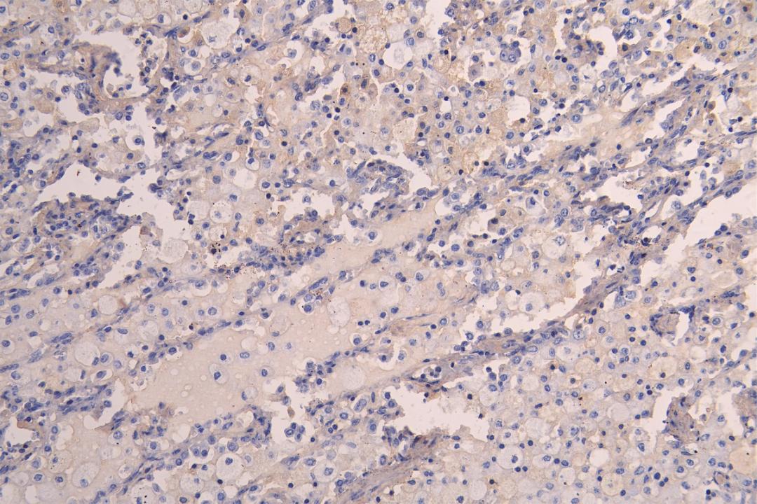 IHC image of CSB-RA012145MA1HU diluted at 1:200 and staining in paraffin-embedded human lung tissue performed on a Leica BondTM system. After dewaxing and hydration, antigen retrieval was mediated by high pressure in a citrate buffer (pH 6.0). Section was blocked with 10% normal goat serum 30min at RT. Then primary antibody (1% BSA) was incubated at 4°C overnight. The primary is detected by a Goat anti-human polymer IgG labeled by HRP and visualized using 0.05% DAB.