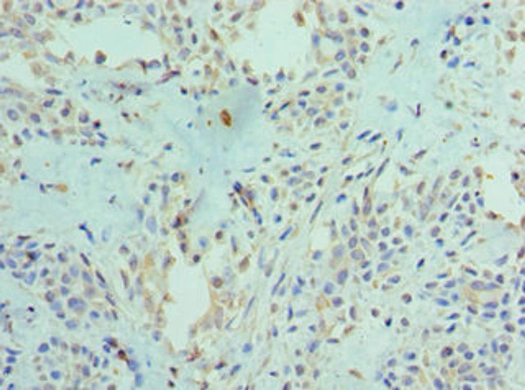 Immunohistochemistry of paraffin-embedded human breast cancer using CSB-PA890757ESR2HU at dilution of 1:100