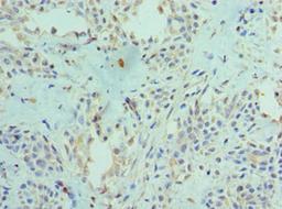 Immunohistochemistry of paraffin-embedded human breast cancer using CSB-PA890757ESR2HU at dilution of 1:100