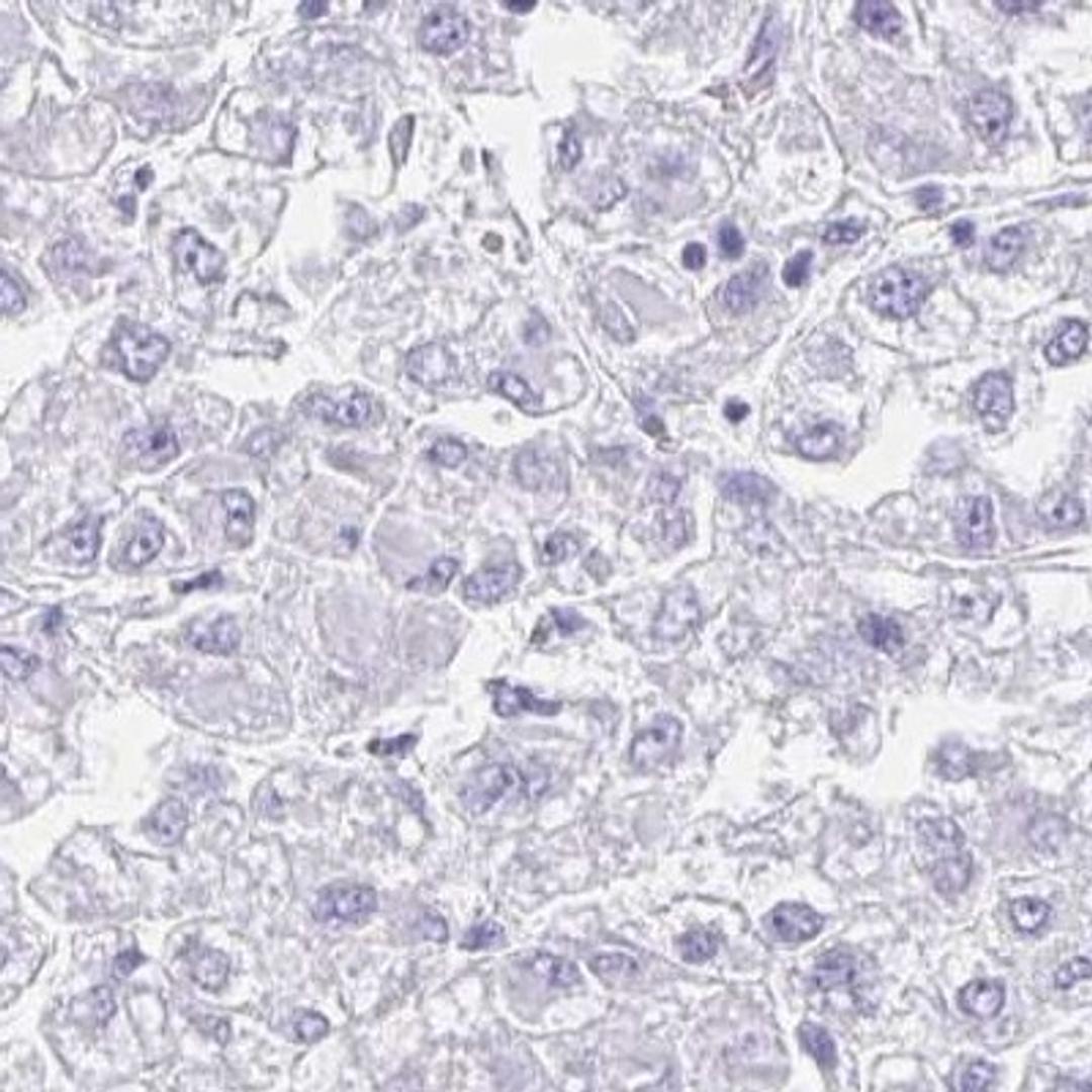 Immunohistochemistry: OR6T1 Antibody [NBP2-32571] - liver cancer