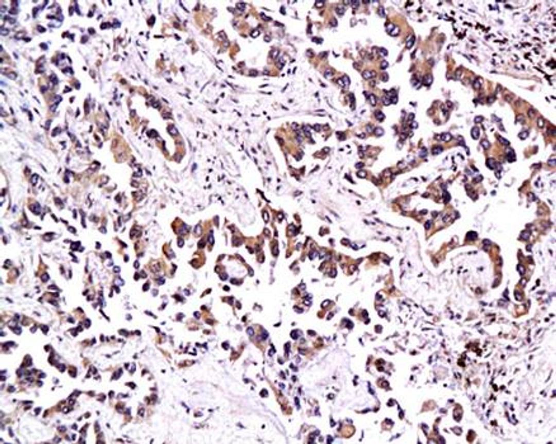 Immunohistochemical analysis of paraffin-embedded human lung adenocarcinoma  tissue using Thrombomodulin antibody 