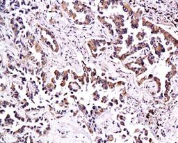 Immunohistochemical analysis of paraffin-embedded human lung adenocarcinoma  tissue using Thrombomodulin antibody 