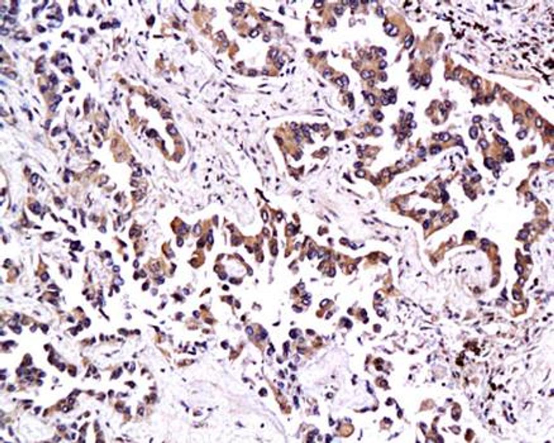 Immunohistochemical analysis of paraffin-embedded human lung adenocarcinoma tissue using Thrombomodulin antibody