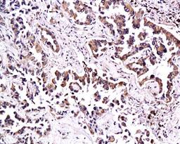 Immunohistochemical analysis of paraffin-embedded human lung adenocarcinoma tissue using Thrombomodulin antibody