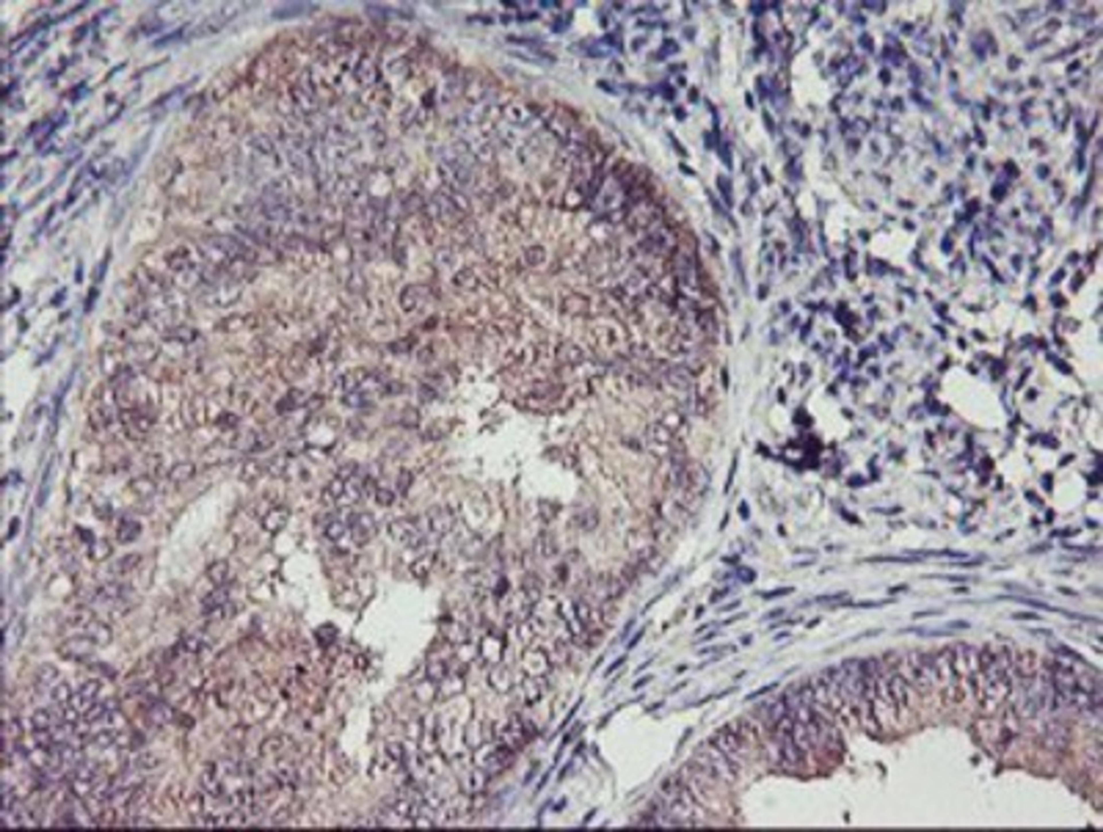 Immunohistochemistry-Paraffin: TMEFF2 Antibody (1F9) [NBP2-01863] - Staining of paraffin-embedded Adenocarcinoma of Human endometrium tissue using anti-TMEFF2 mouse monoclonal antibody.