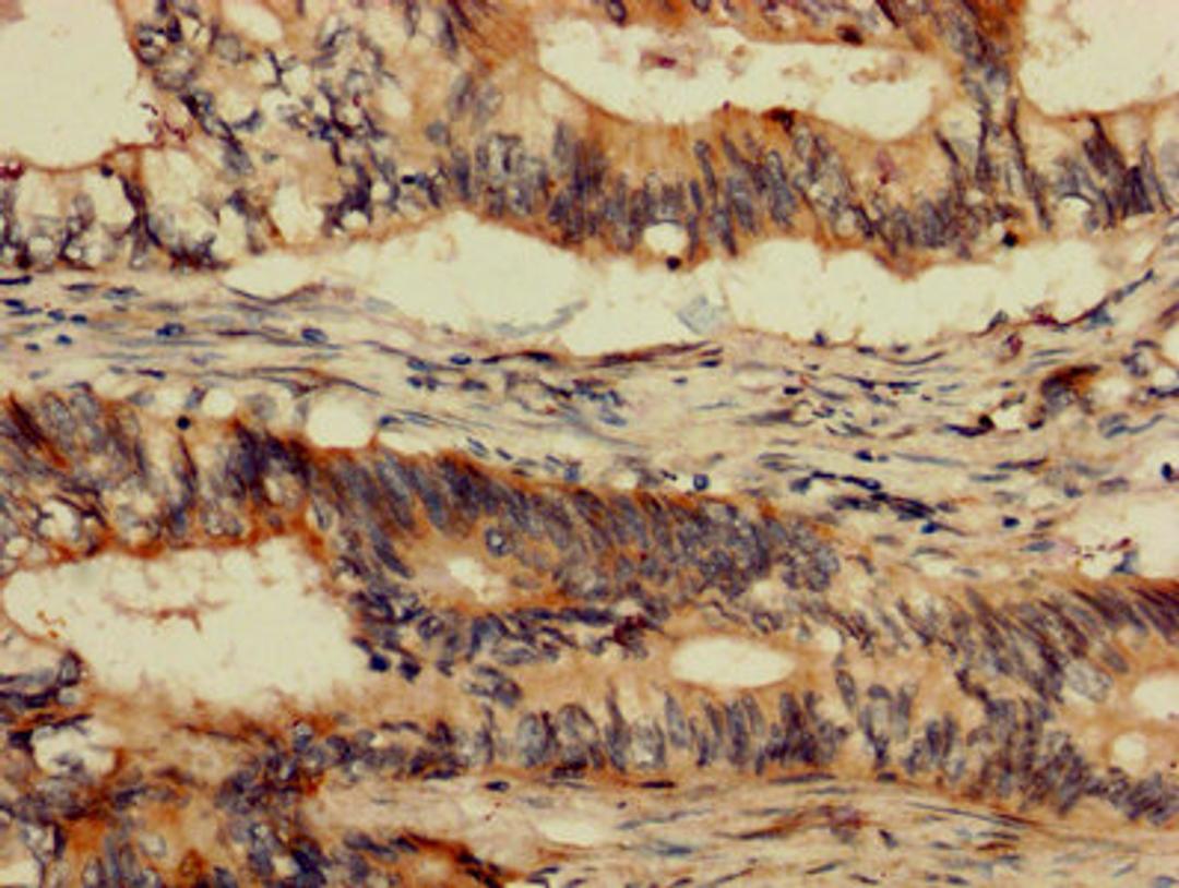 IHC image of CSB-PA04355A0Rb diluted at 1:1200 and staining in paraffin-embedded human colon cancer performed on a Leica BondTM system. After dewaxing and hydration, antigen retrieval was mediated by high pressure in a citrate buffer (pH 6.0). Section was blocked with 10% normal goat serum 30min at RT. Then primary antibody (1% BSA) was incubated at 4&deg;C overnight. The primary is detected by a biotinylated secondary antibody and visualized using an HRP conjugated SP system.