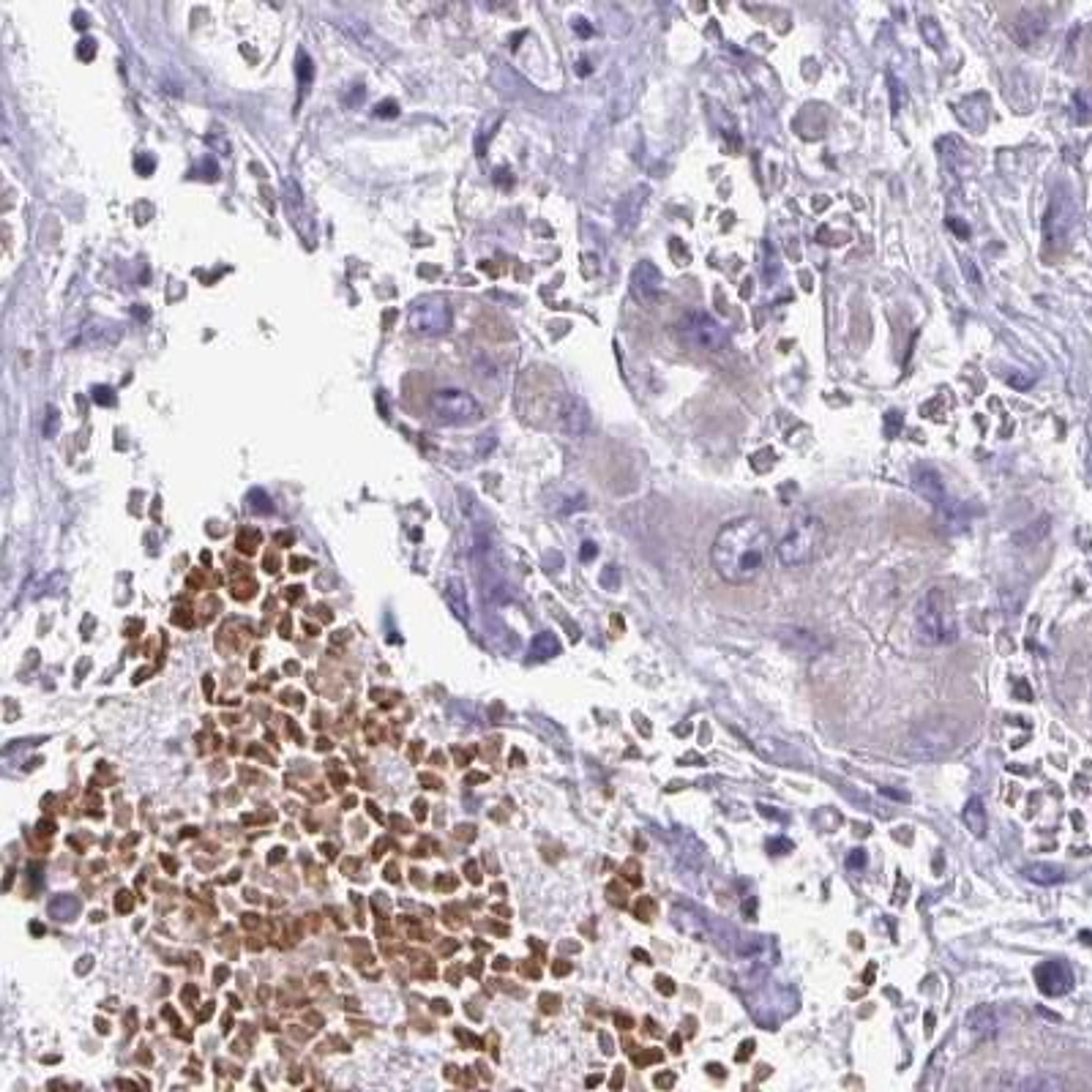 Immunohistochemistry: FN3K Antibody [NBP2-32349] - liver cancer