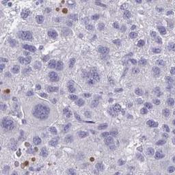 Immunohistochemistry: Fc epsilon RI beta/MS4A2 Antibody [NBP2-31807] - Liver cancer