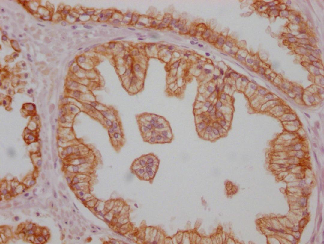 IHC image of CSB-MA999890 diluted at 1:100 and staining in paraffin-embedded human prostate cancer performed on a Leica BondTM system. After dewaxing and hydration, antigen retrieval was mediated by high pressure in a citrate buffer (pH 6.0). Section was blocked with 10% normal goat serum 30min at RT. Then primary antibody (1% BSA) was incubated at 4°C overnight. The primary is detected by a Goat anti-mouse IgG polymer labeled by HRP and visualized using 0.05% DAB.