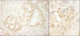 Immunohistochemistry-Paraffin: LEO1 Antibody [NB600-276] - Human stomach carcinoma (left) and mouse teratoma (right).  Antibody used at a dilution of 1:5,000.