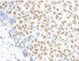 Immunohistochemistry-Paraffin: MAD2L1 Antibody [NB100-563] - Section of human lung carcinoma.