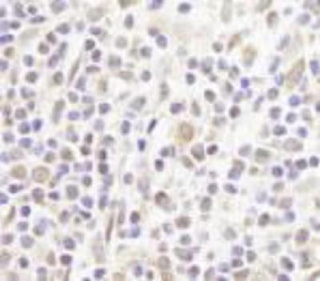 Immunohistochemistry-Paraffin: ZFPM1 Antibody [NB100-68241] - FFPE section of human Hodgkin's Lymphoma.  Affinity purified rabbit anti-FOG1/ZFPM1 used at a dilution of 1:250.