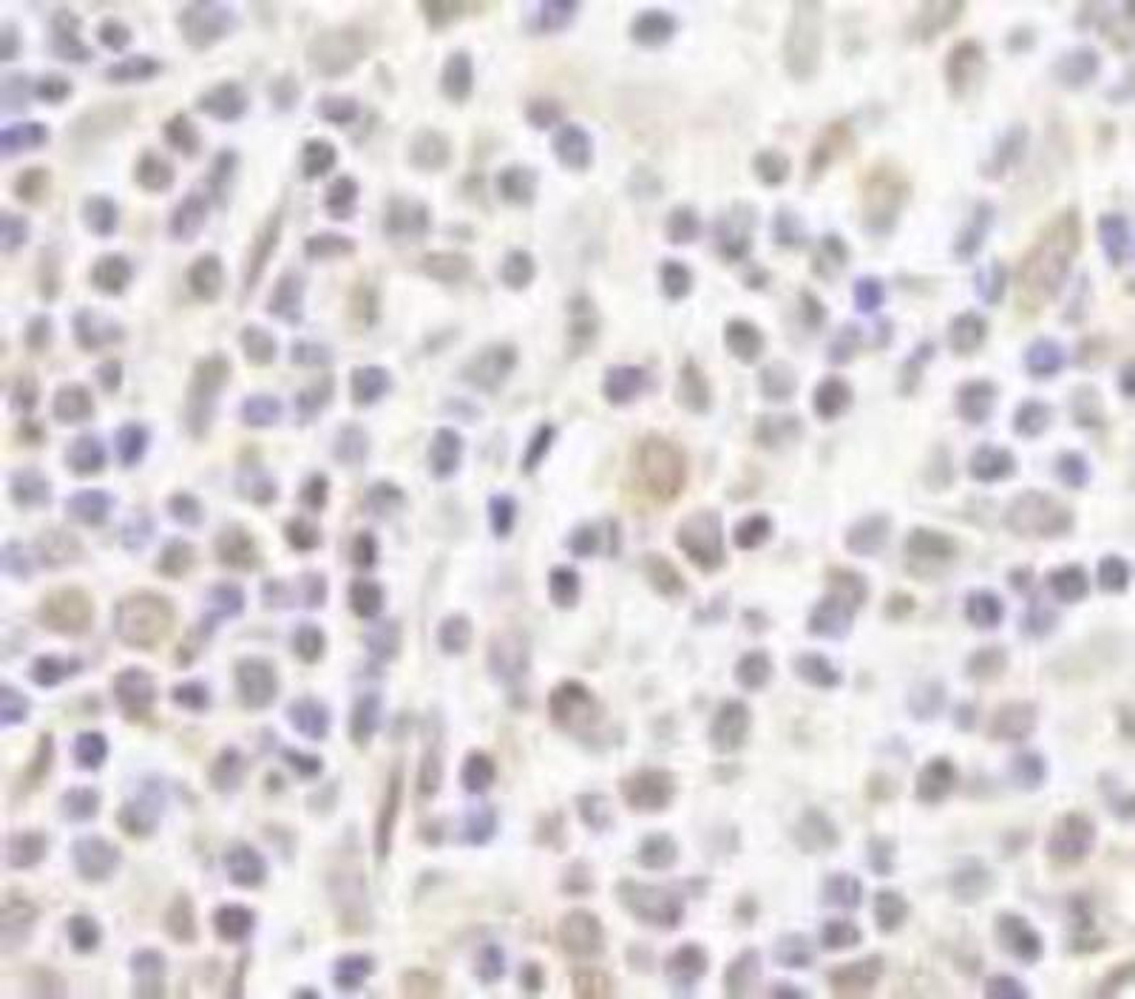 Immunohistochemistry-Paraffin: ZFPM1 Antibody [NB100-68241] - FFPE section of human Hodgkin's Lymphoma.  Affinity purified rabbit anti-FOG1/ZFPM1 used at a dilution of 1:250.