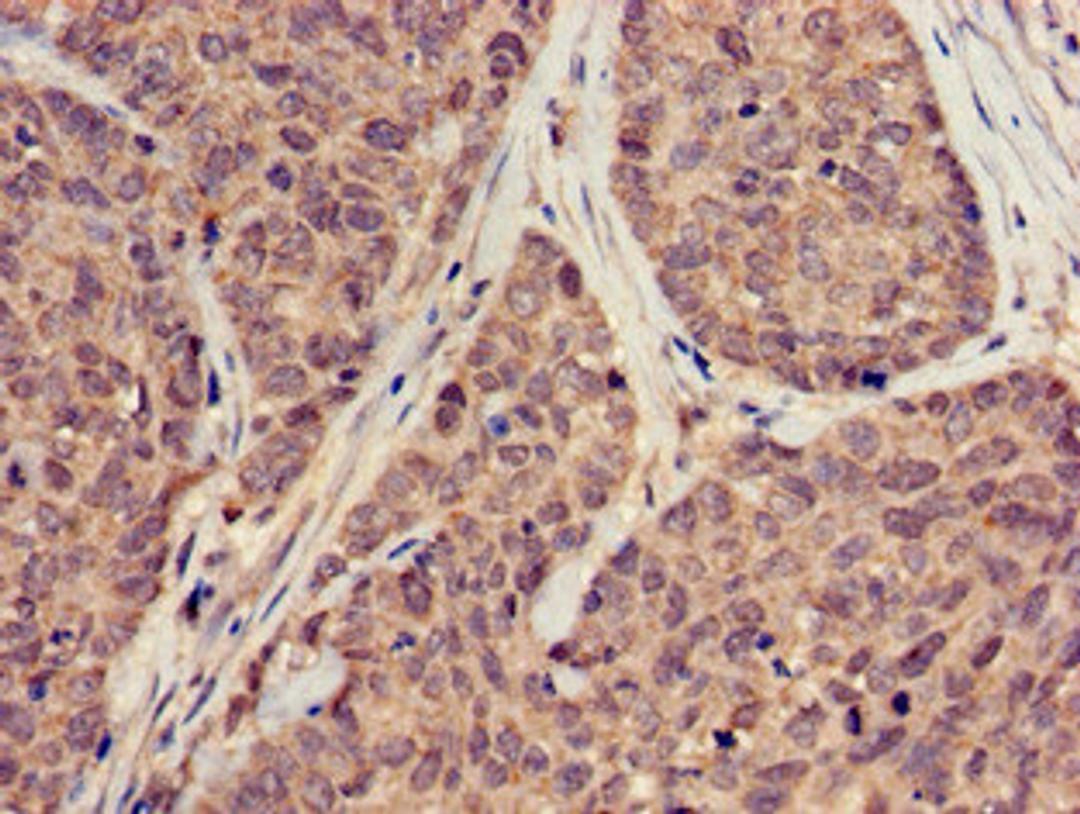 Immunohistochemistry of paraffin-embedded human ovarian cancer using CSB-PA05509A0Rb at dilution of 1:100