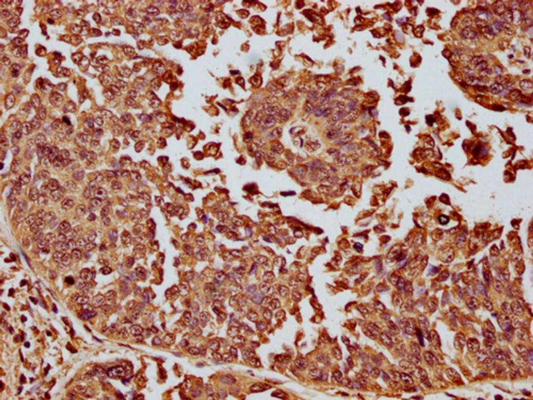 IHC image of CSB-PA010087OA11nme1HU diluted at 1:10 and staining in paraffin-embedded human cervical cancer performed on a Leica BondTM system. After dewaxing and hydration, antigen retrieval was mediated by high pressure in a citrate buffer (pH 6.0). Section was blocked with 10% normal goat serum 30min at RT. Then primary antibody (1% BSA) was incubated at 4°C overnight. The primary is detected by a biotinylated secondary antibody and visualized using an HRP conjugated SP system.