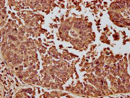 IHC image of CSB-PA010087OA11nme1HU diluted at 1:10 and staining in paraffin-embedded human cervical cancer performed on a Leica BondTM system. After dewaxing and hydration, antigen retrieval was mediated by high pressure in a citrate buffer (pH 6.0). Section was blocked with 10% normal goat serum 30min at RT. Then primary antibody (1% BSA) was incubated at 4°C overnight. The primary is detected by a biotinylated secondary antibody and visualized using an HRP conjugated SP system.