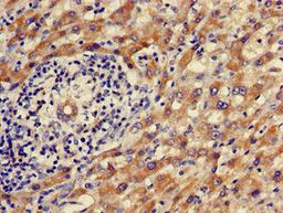 Immunohistochemistry of paraffin-embedded human liver cancer using CSB-PA001582LA01HU at dilution of 1:100