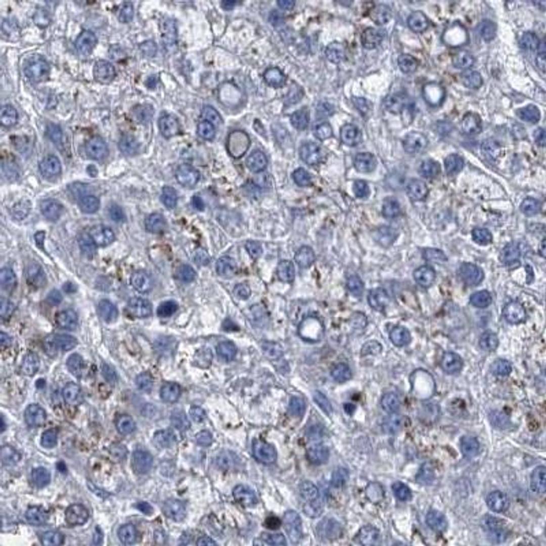 Immunohistochemistry: C4.4A/LYPD3 Antibody [NBP2-32598] - Liver cancer