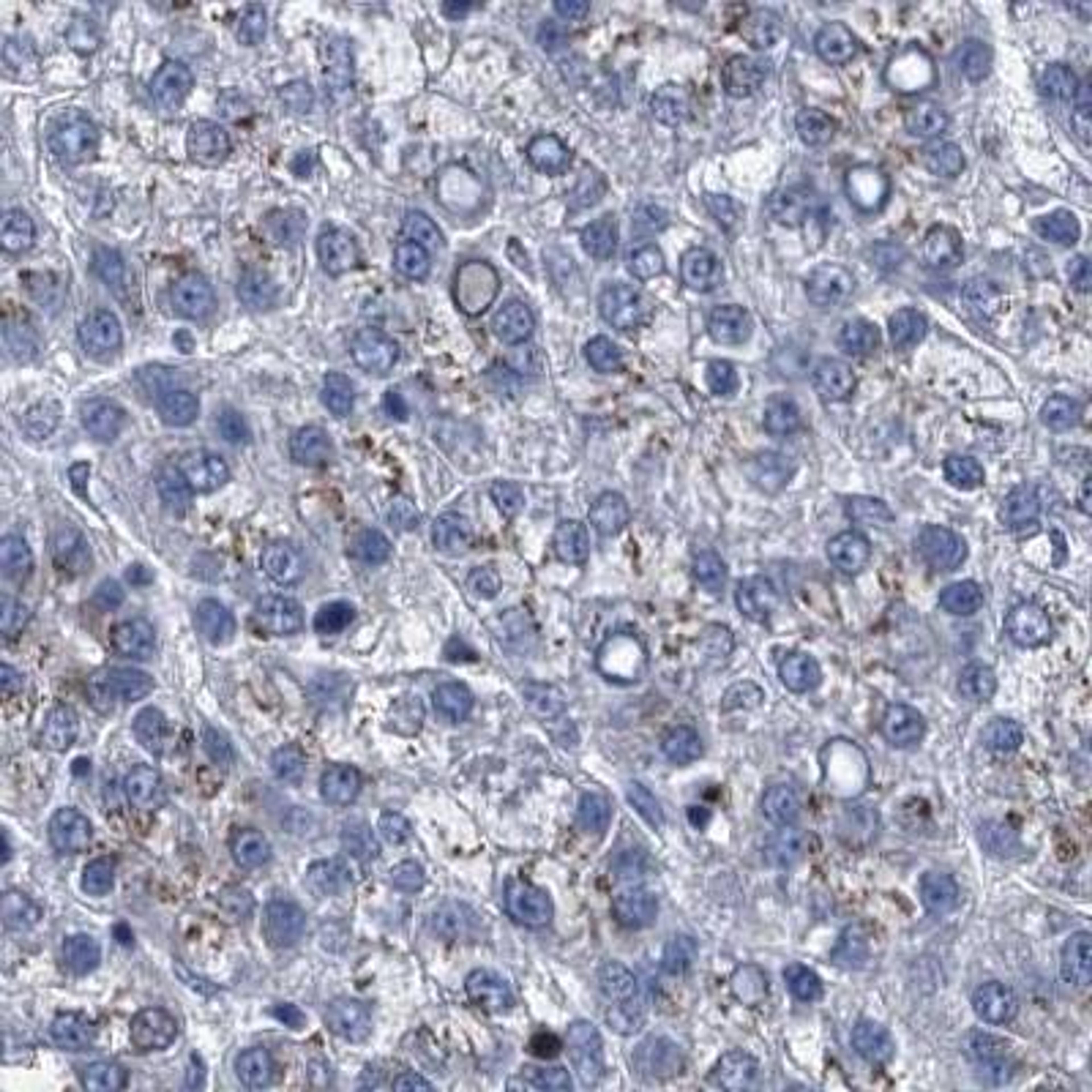 Immunohistochemistry: C4.4A/LYPD3 Antibody [NBP2-32598] - Liver cancer