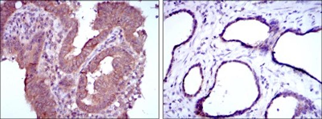 Immunohistochemistry: MTHFR Antibody (5D3) [NBP2-37607] - Immunohistochemical analysis of paraffin-embedded intima cancer tissues (left) and prostate tissues (right) using MTHFR mouse mAb with DAB staining.