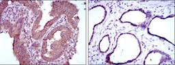 Immunohistochemistry: MTHFR Antibody (5D3) [NBP2-37607] - Immunohistochemical analysis of paraffin-embedded intima cancer tissues (left) and prostate tissues (right) using MTHFR mouse mAb with DAB staining.