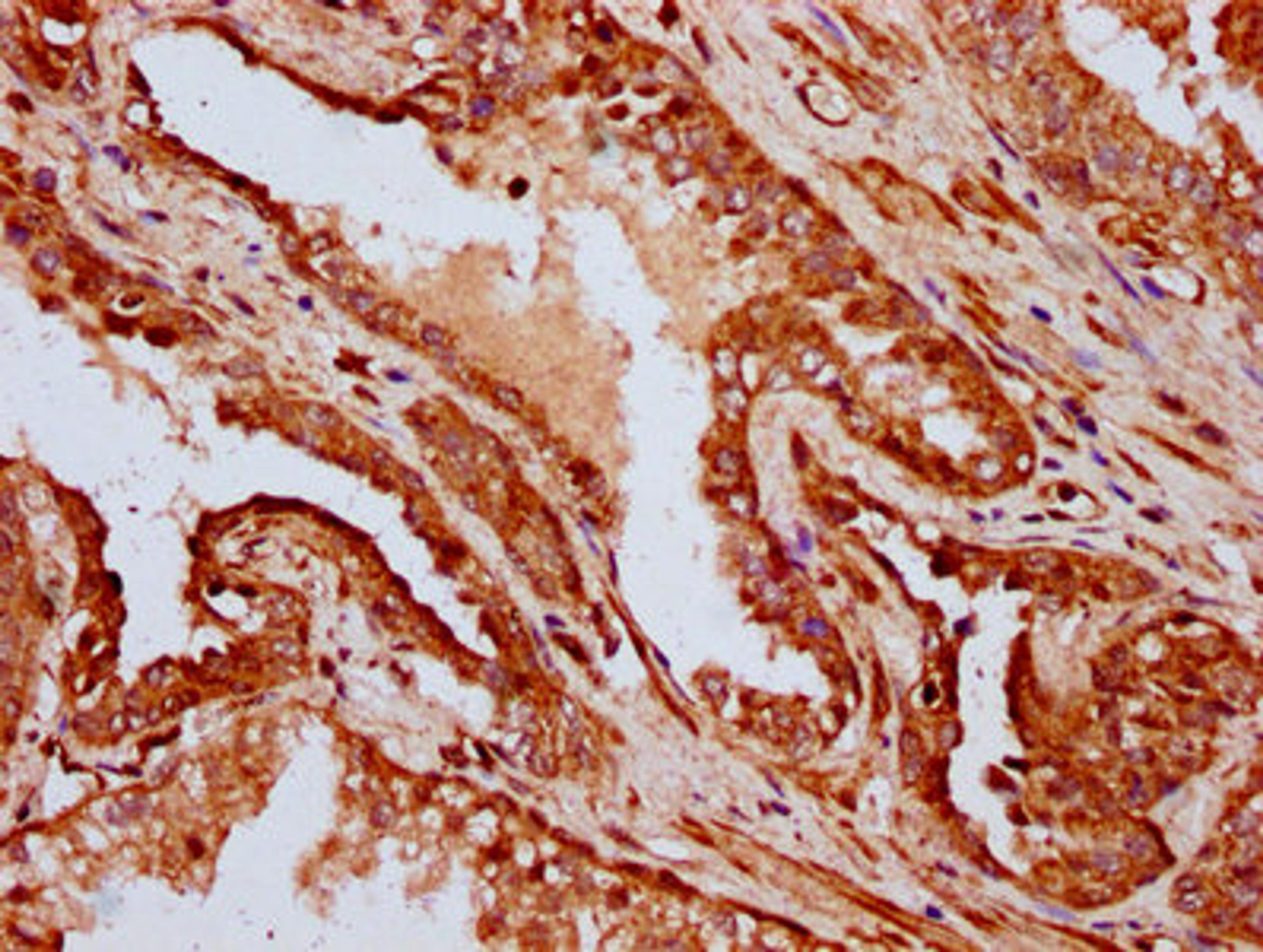 IHC image of CSB-PA887019LA01HU diluted at 1:400 and staining in paraffin-embedded human prostate cancer performed on a Leica BondTM system. After dewaxing and hydration, antigen retrieval was mediated by high pressure in a citrate buffer (pH 6.0). Section was blocked with 10% normal goat serum 30min at RT. Then primary antibody (1% BSA) was incubated at 4°C overnight. The primary is detected by a biotinylated secondary antibody and visualized using an HRP conjugated SP system.