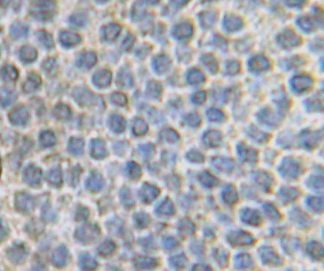 This antibody stained formalin-fixed paraffin-embedded sections of human carcinoid tissue. The recommended concentration is 1.0 ug/ml - 2.5 ug/ml with an overnight iincubation at 4&#730;C. An HRP-labeled polymer detection system was used with a DAB chromo