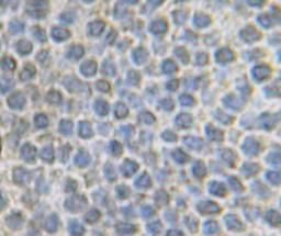 This antibody stained formalin-fixed paraffin-embedded sections of human carcinoid tissue. The recommended concentration is 1.0 ug/ml - 2.5 ug/ml with an overnight iincubation at 4&#730;C. An HRP-labeled polymer detection system was used with a DAB chromo