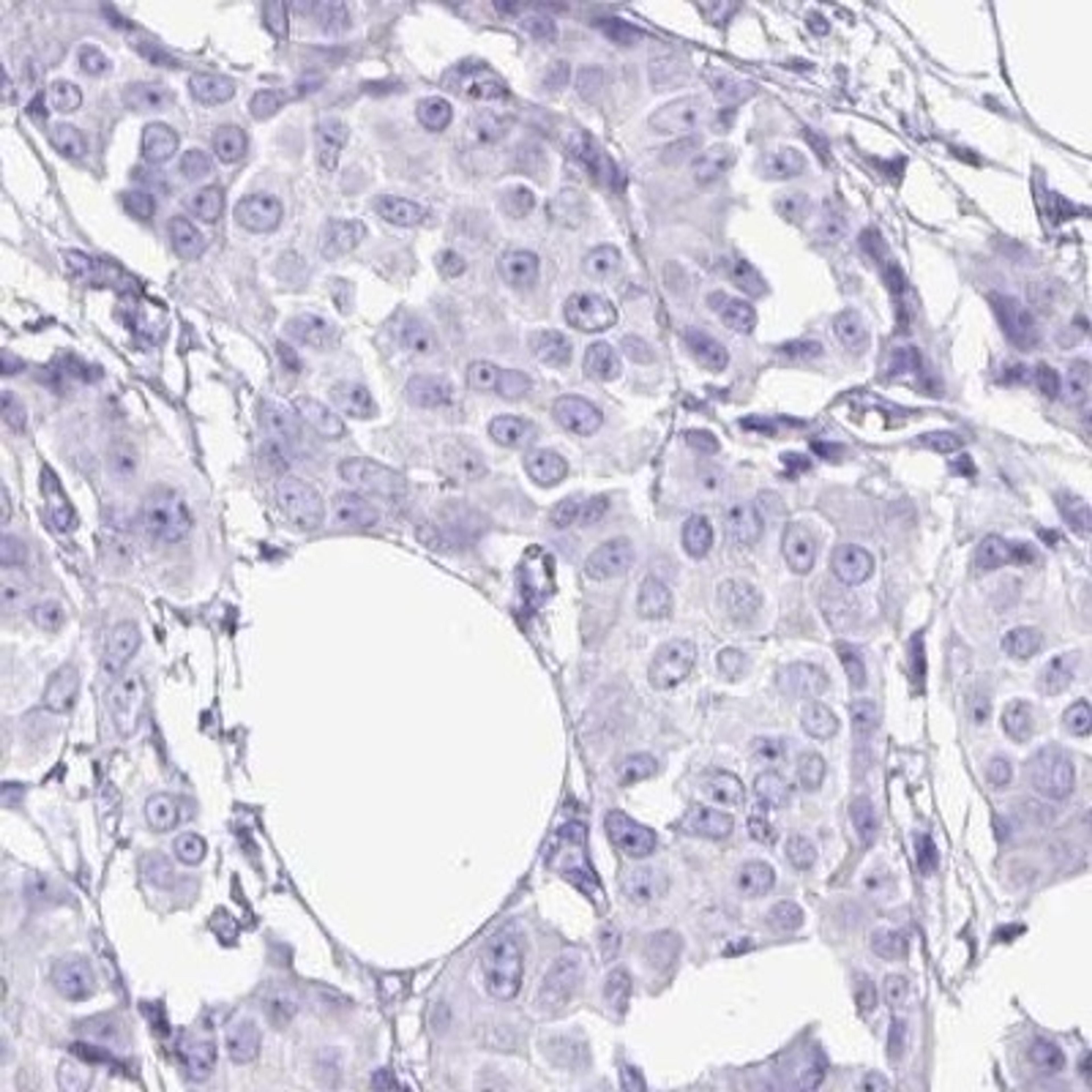 Immunohistochemistry: OVGP1 Antibody [NBP2-32357] - breast cancer