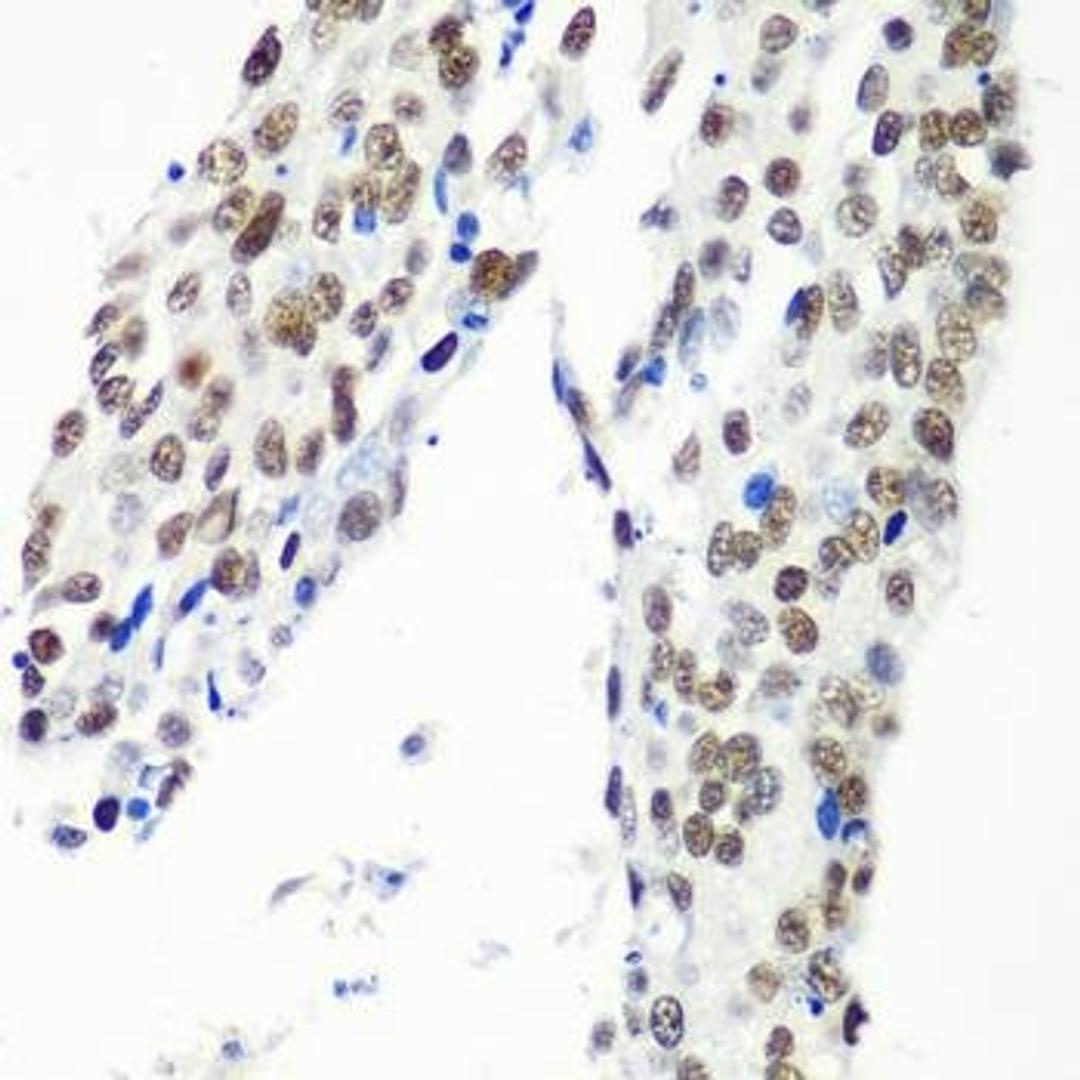 Immunohistochemical staining of human lung cancer tissue using HTATSF1 antibody (dilution of 1:100)