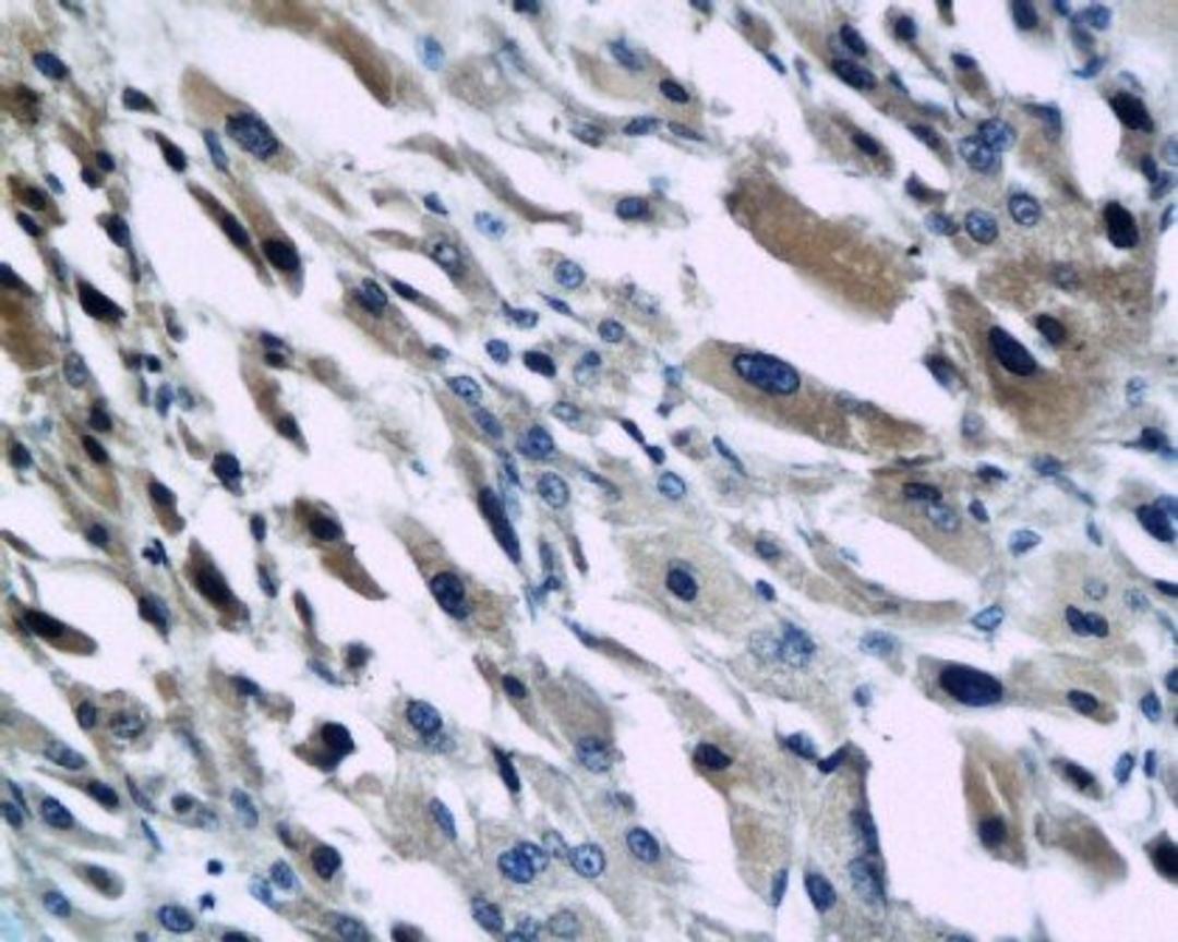 IHC of human hepatocellular carcinoma using GRO beta antibody