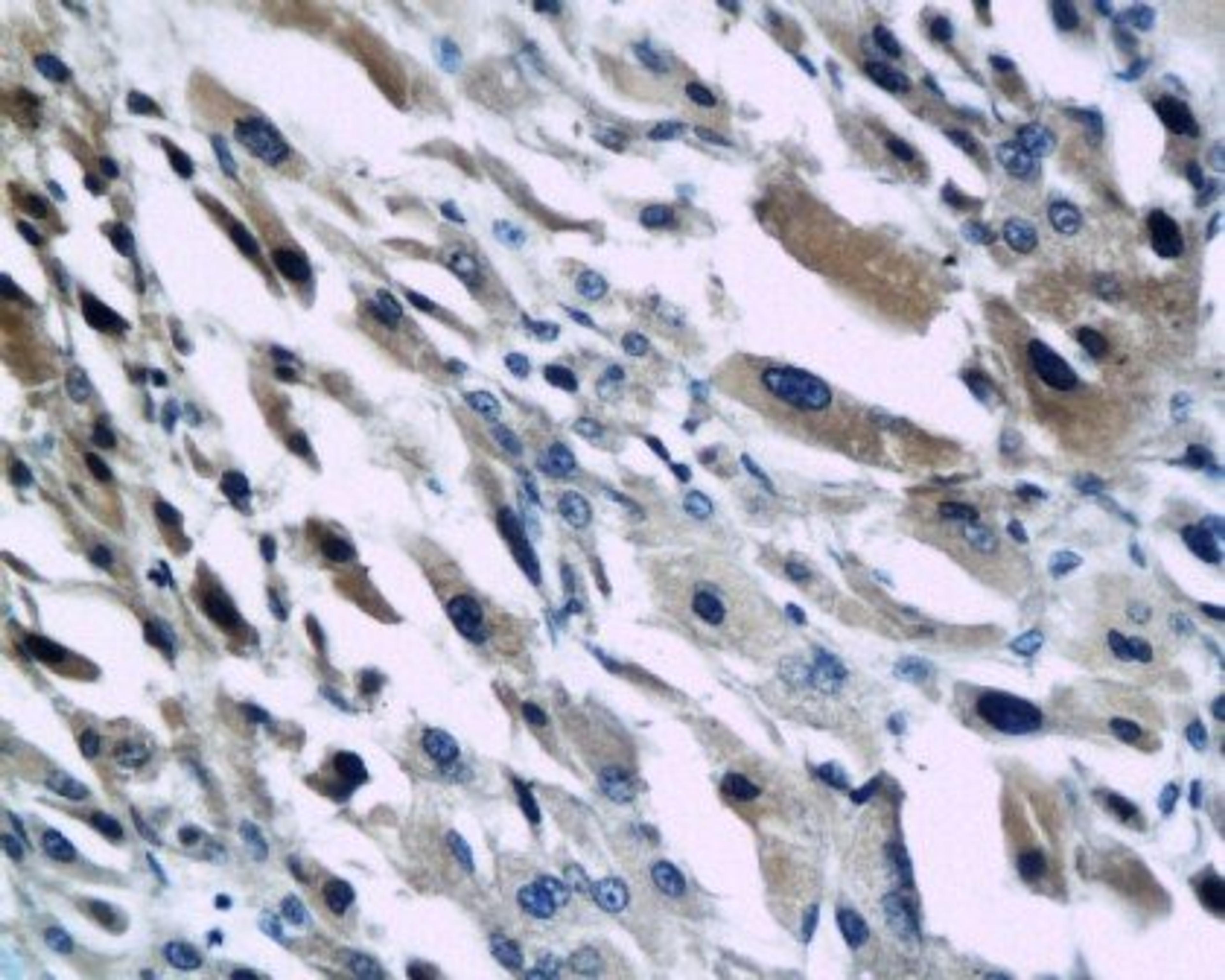 IHC of human hepatocellular carcinoma using GRO beta antibody