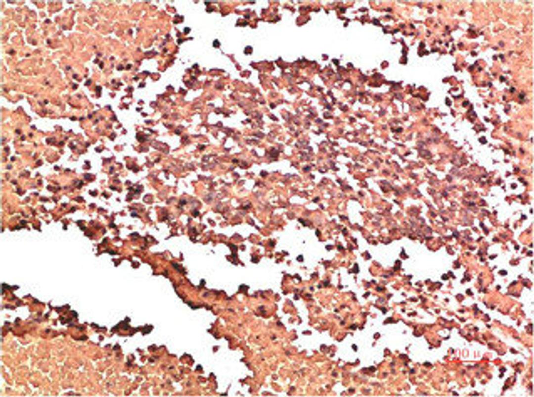 Immunohistochemical analysis of paraffin-embedded Human Lung Carcinoma Tissue using Collagen II Mouse mAb diluted at 1:200.