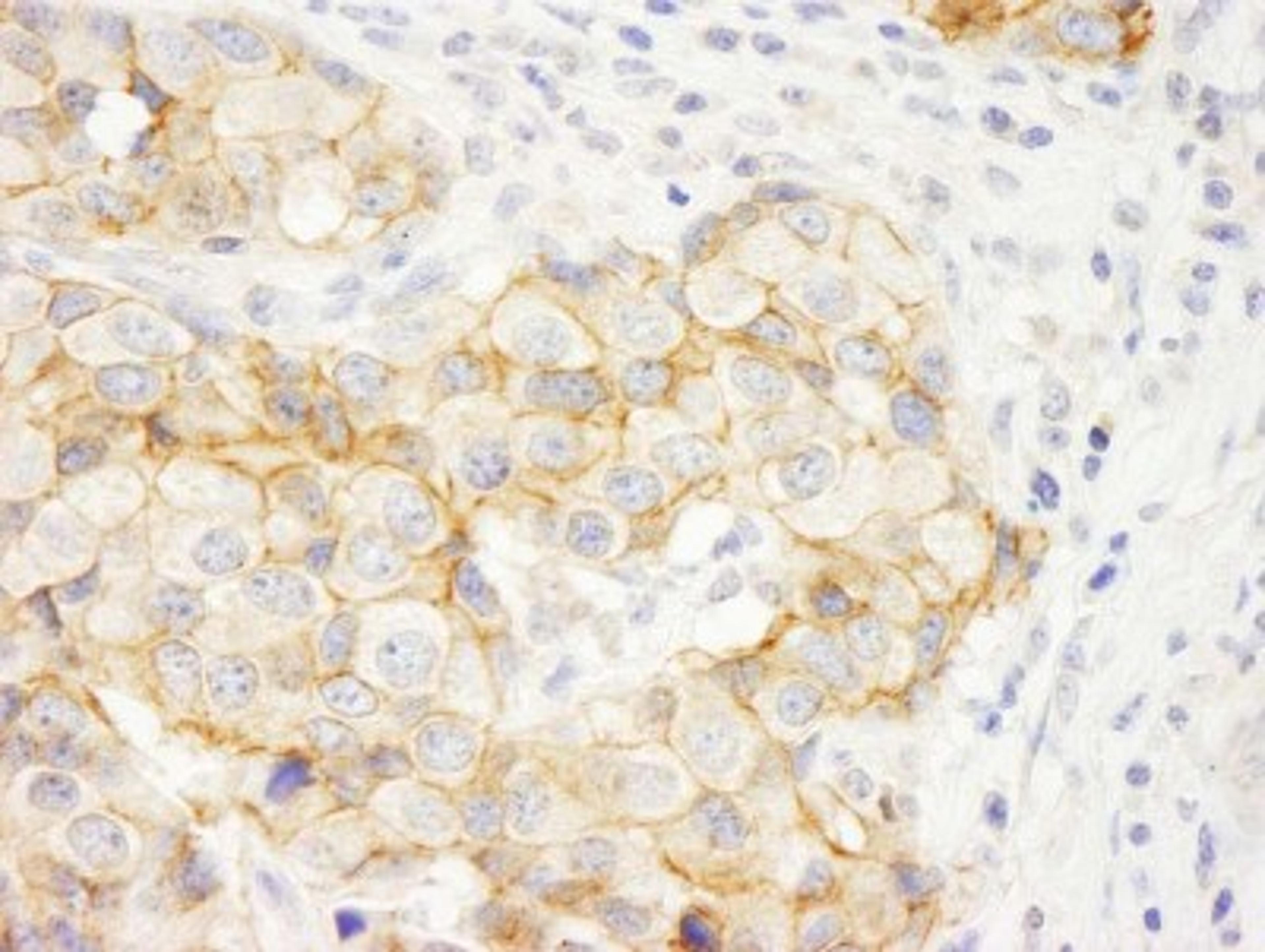 Immunohistochemistry-Paraffin: KIAA0528 Antibody [NB100-74596] - Human breast carcinoma. Antibody used at a dilution of 1:1,000.