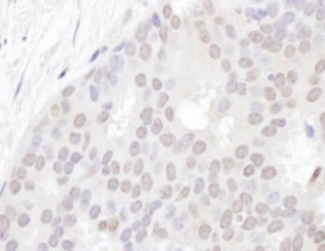 Immunohistochemistry-Paraffin: YLPM1 Antibody [NBP2-22326] - FFPE section of human breast carcinoma. Antibody: Affinity purified rabbit anti-ZAP3 used at a dilution of 1:1,000 (1ug/ml). Detection: DAB. Counterstain: IHC Hematoxylin (blue).