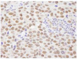 Immunohistochemistry-Paraffin: PPM1G Antibody [NB110-38867] - FFPE section of human breast adenocarcinoma.  Affinity purified rabbit anti-PPM1G used at a dilution of 1:500.