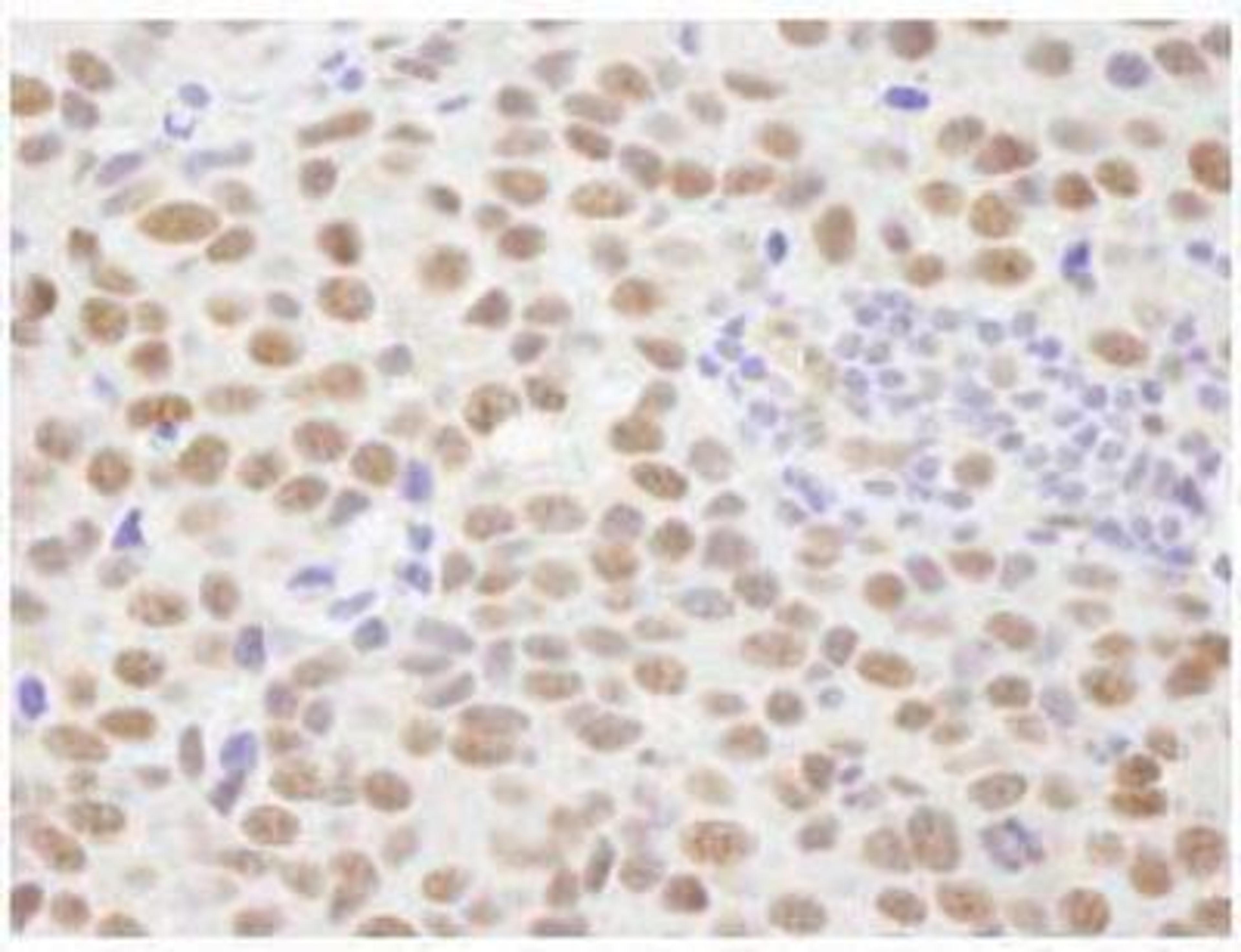 Immunohistochemistry-Paraffin: PPM1G Antibody [NB110-38867] - FFPE section of human breast adenocarcinoma.  Affinity purified rabbit anti-PPM1G used at a dilution of 1:500.