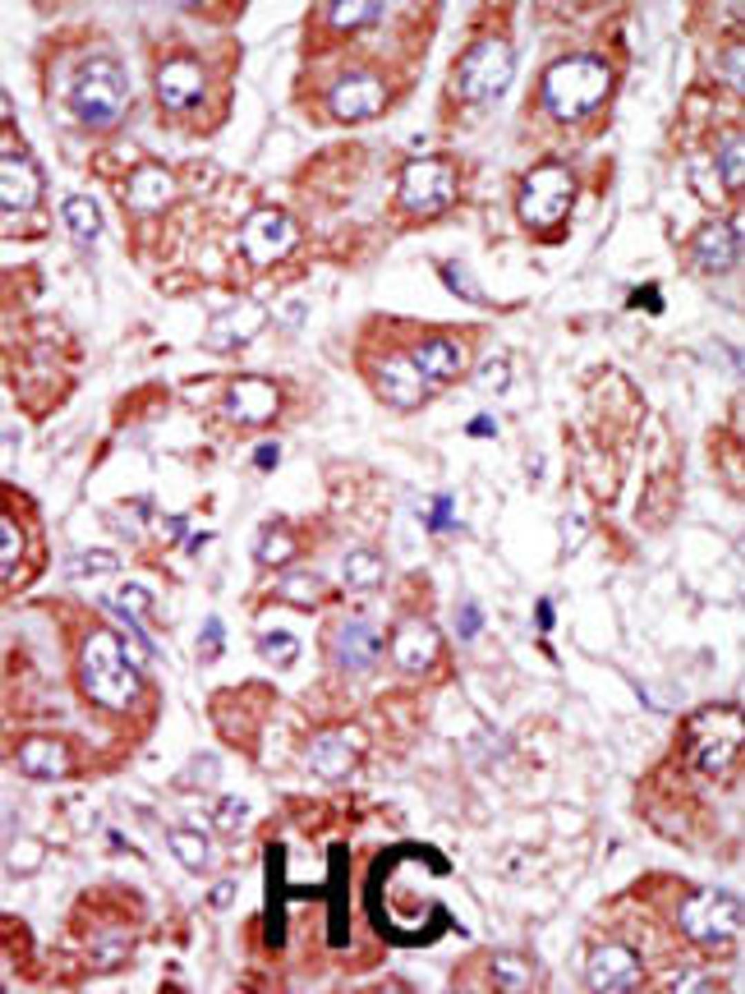 Formalin-fixed and paraffin-embedded human cancer tissue reacted with the primary antibody, which was peroxidase-conjugated to the secondary antibody, followed by DAB staining. BC = breast carcinoma; HC = hepatocarcinoma.