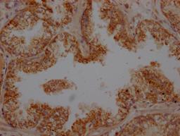 IHC image of CSB-RA963043A0HU diluted at 1:100 and staining in paraffin-embedded human prostate cancer performed on a Leica BondTM system. After dewaxing and hydration, antigen retrieval was mediated by high pressure in a citrate buffer (pH 6.0). Section was blocked with 10% normal goat serum 30min at RT. Then primary antibody (1% BSA) was incubated at 4℃ overnight. The primary is detected by a Goat anti-rabbit IgG polymer labeled by HRP and visualized using 0.05% DAB.
