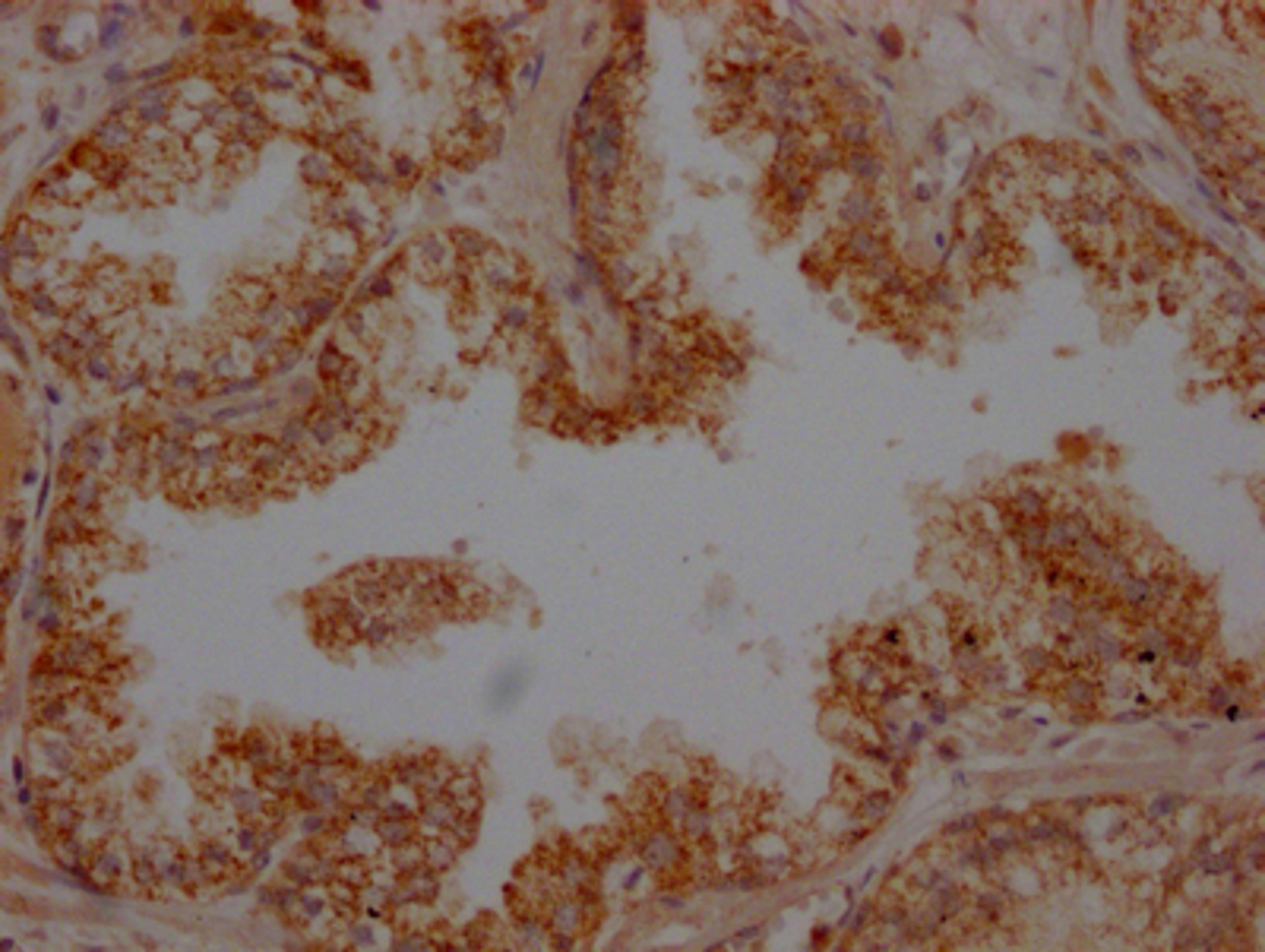 IHC image of CSB-RA963043A0HU diluted at 1:100 and staining in paraffin-embedded human prostate cancer performed on a Leica BondTM system. After dewaxing and hydration, antigen retrieval was mediated by high pressure in a citrate buffer (pH 6.0). Section was blocked with 10% normal goat serum 30min at RT. Then primary antibody (1% BSA) was incubated at 4℃ overnight. The primary is detected by a Goat anti-rabbit IgG polymer labeled by HRP and visualized using 0.05% DAB.