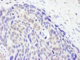 Immunohistochemistry: TET2 Antibody [NBP2-32104] - Section of human ovarian carcinoma.