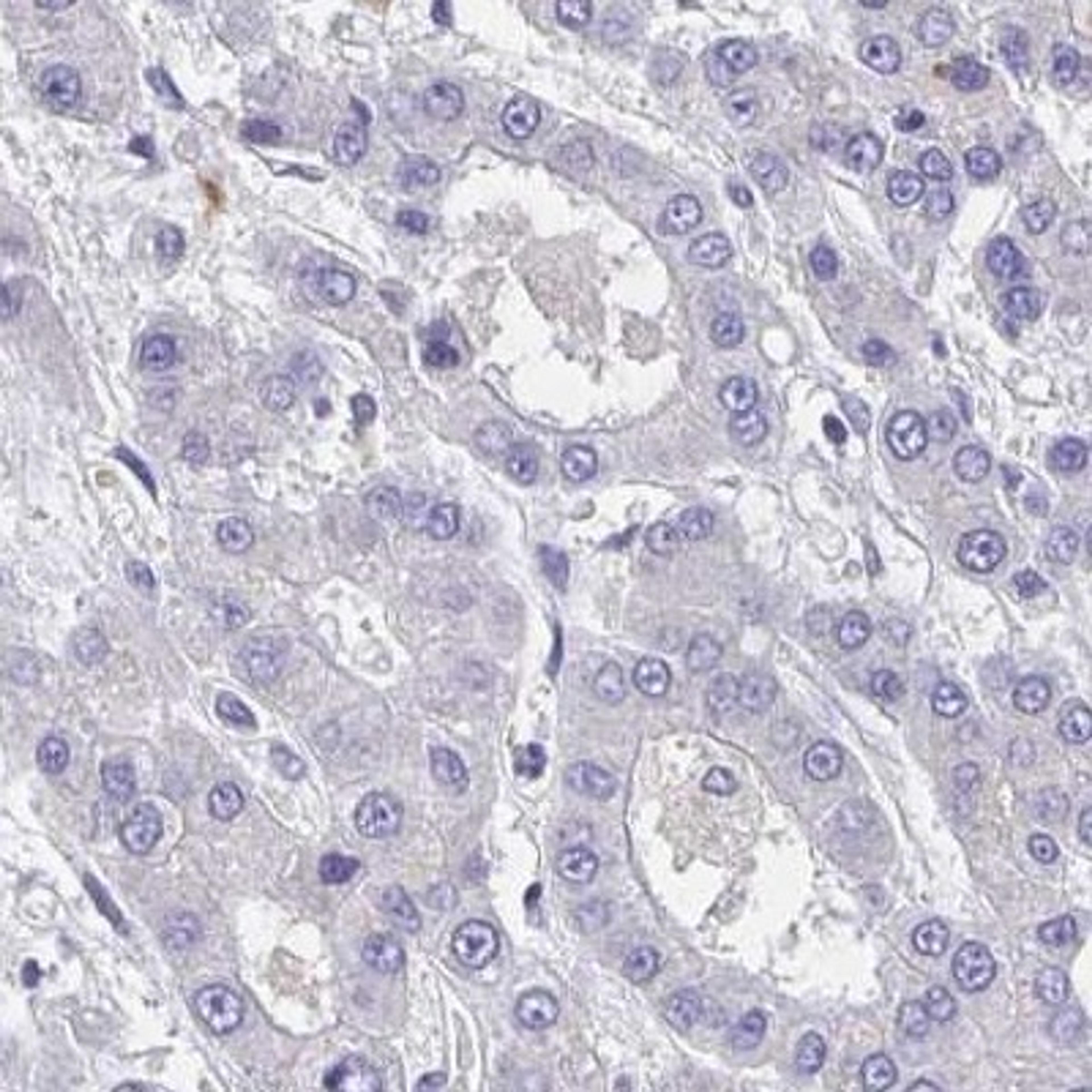 Immunohistochemistry: CA10 Antibody [NBP2-31586] - liver cancer