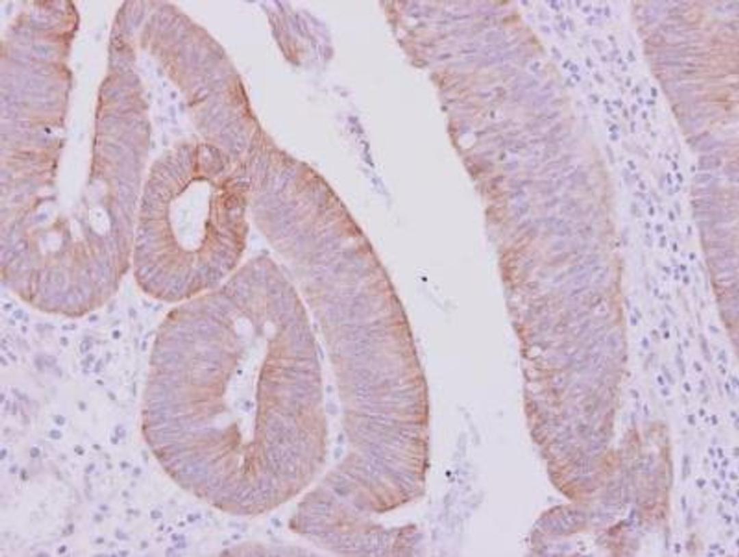 Immunohistochemistry-Paraffin: Cytokeratin 71 Antibody [NBP2-17040] - Membrane on colon carcinoma.