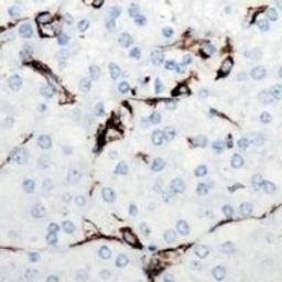 Immunohistochemical staining of human breast cancer tissue using LEP antibody