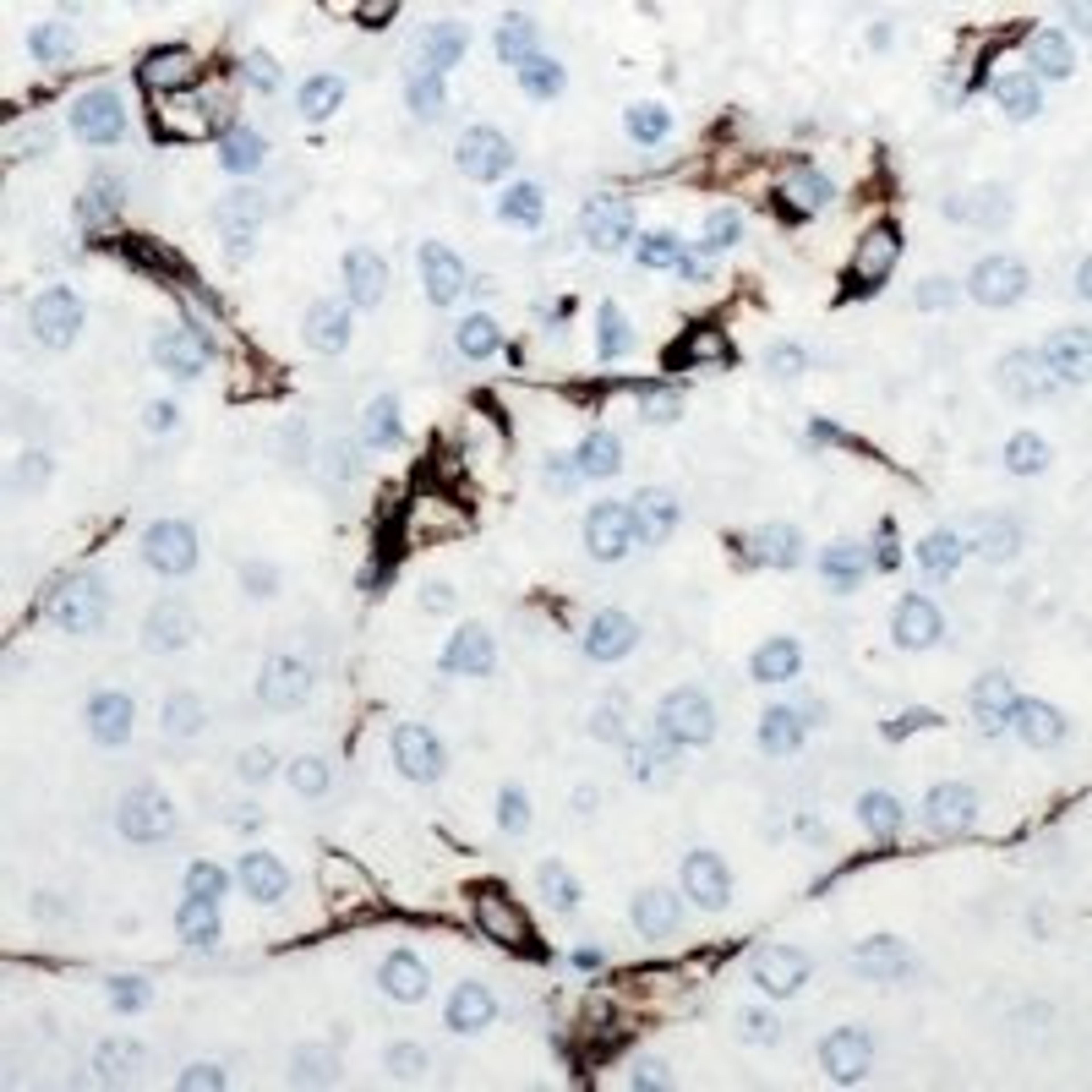 Immunohistochemical staining of human breast cancer tissue using LEP antibody