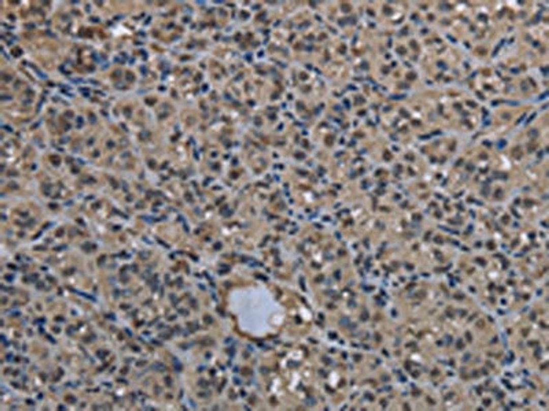 The image on the left is immunohistochemistry of paraffin-embedded Human thyroid cancer tissue using CSB-PA118714(UBB Antibody) at dilution 1/20, on the right is treated with fusion protein. (Original magnification: ×200)