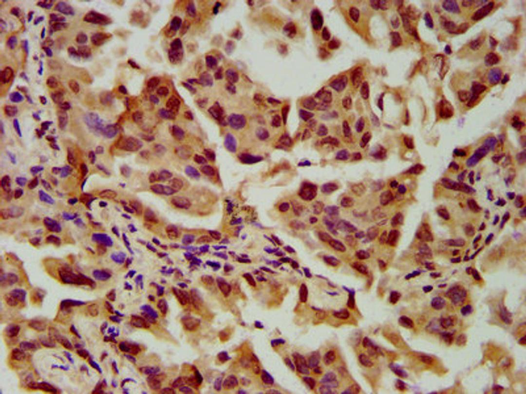 IHC image of CSB-PA021558LA01HU diluted at 1:600 and staining in paraffin-embedded human lung cancer performed on a Leica BondTM system. After dewaxing and hydration, antigen retrieval was mediated by high pressure in a citrate buffer (pH 6.0). Section was blocked with 10% normal goat serum 30min at RT. Then primary antibody (1% BSA) was incubated at 4°C overnight. The primary is detected by a biotinylated secondary antibody and visualized using an HRP conjugated SP system.