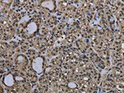 The image on the left is immunohistochemistry of paraffin-embedded Human thyroid cancer tissue using CSB-PA179850(UBB Antibody) at dilution 1/20, on the right is treated with fusion protein. (Original magnification: ×200)