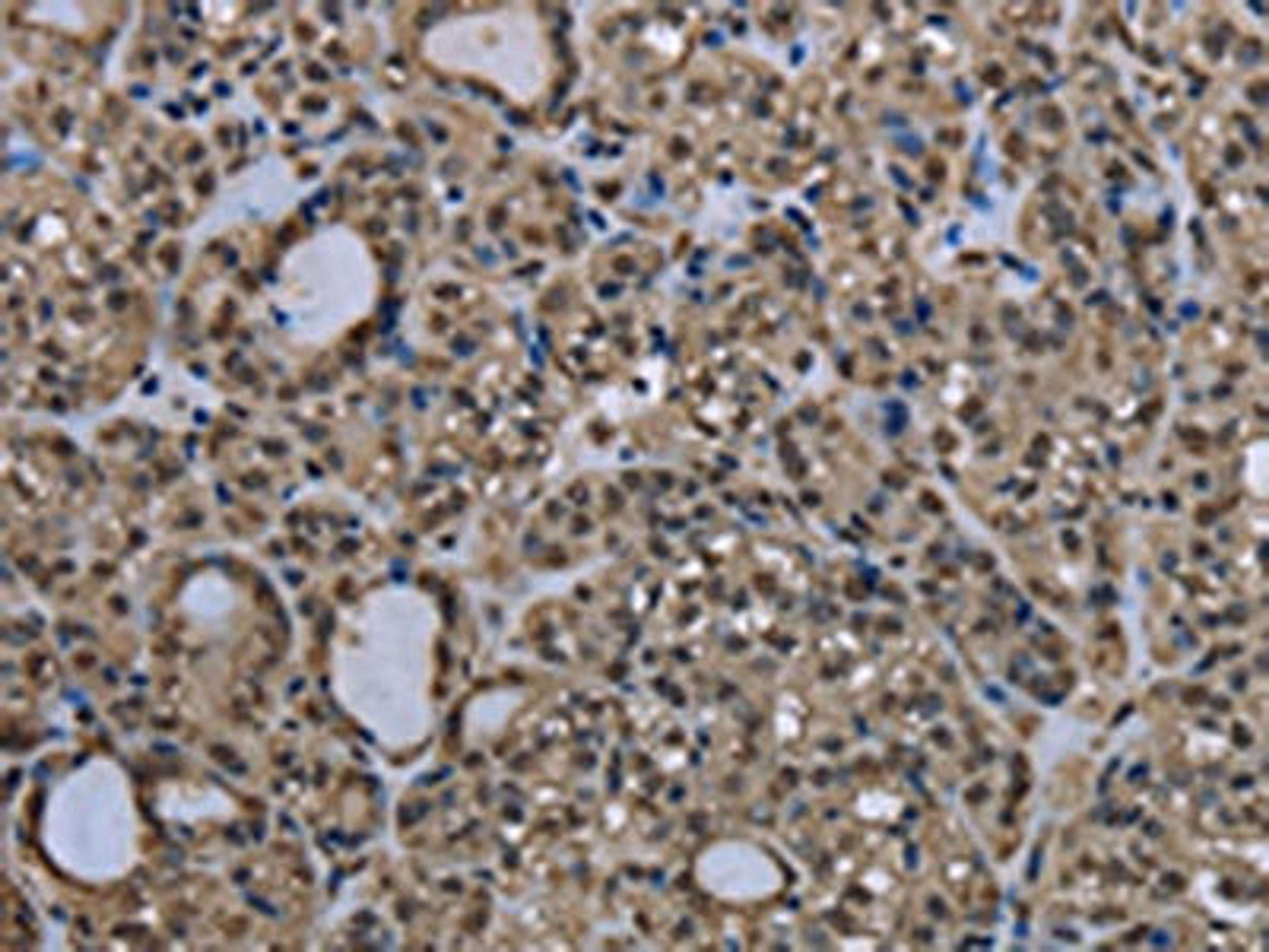 The image on the left is immunohistochemistry of paraffin-embedded Human thyroid cancer tissue using CSB-PA179850(UBB Antibody) at dilution 1/20, on the right is treated with fusion protein. (Original magnification: ×200)