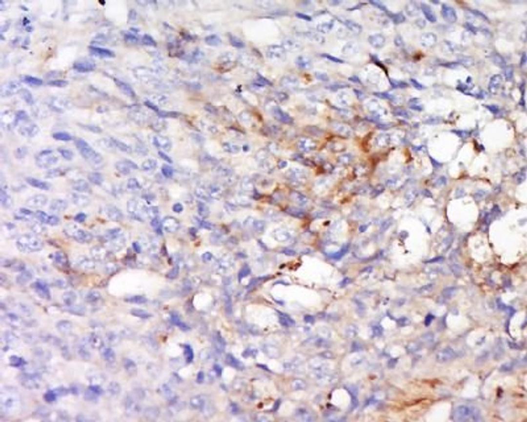 Immunohistochemical staining of human colon cancer tissue using FAM150A antibody.